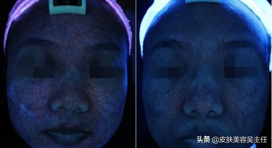 visia皮肤检测分高低吗,visia皮肤检测值多少是正常的