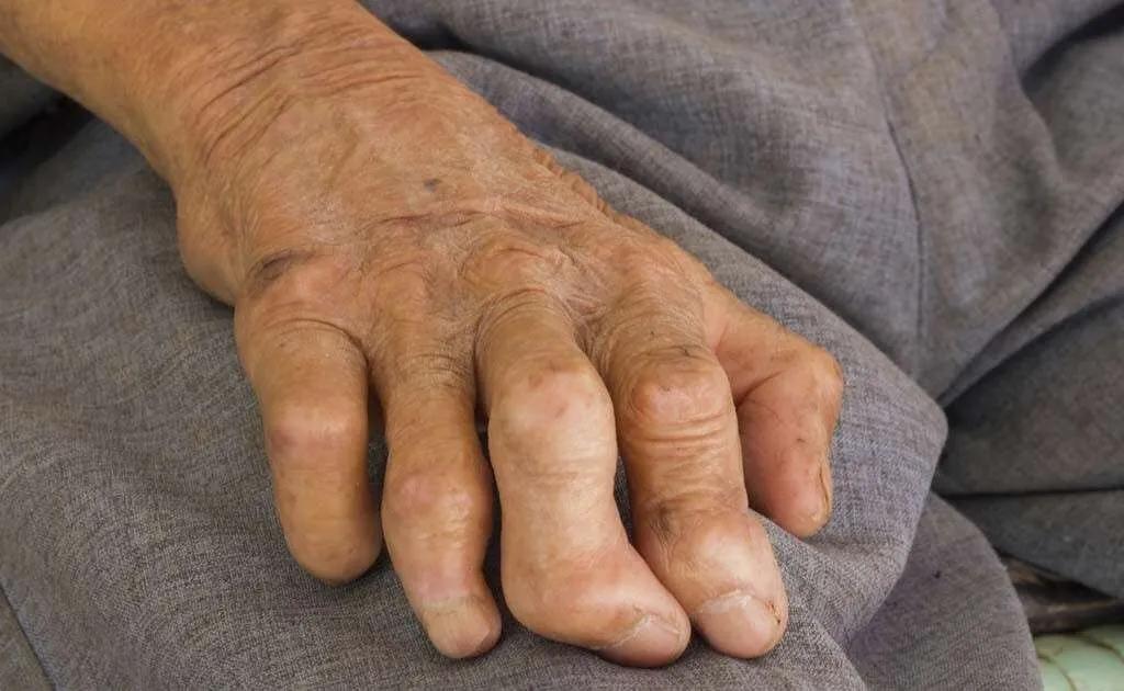 疫情期间，类风湿性关节炎急性发作应这样处理，否则追悔莫及