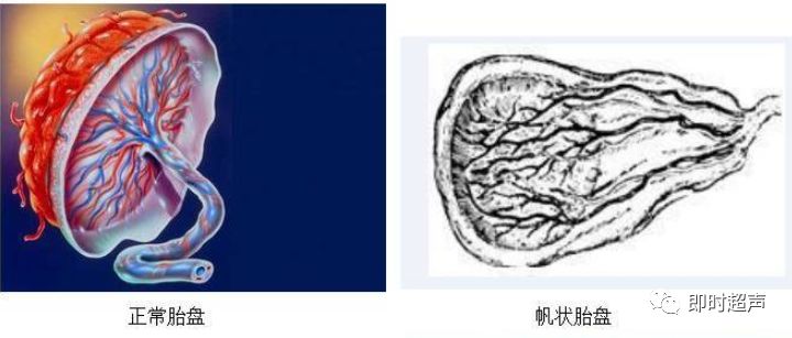 帆状胎盘变普通胎盘,帆状胎盘是由啥原因导致的