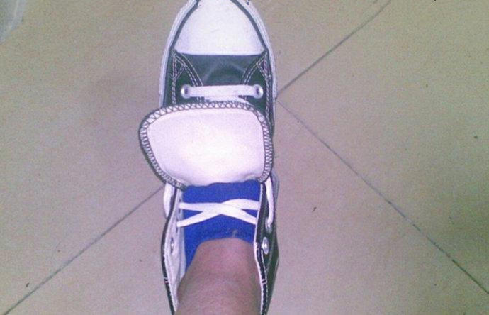 鞋舌跑偏怎么办教你一招,鞋舌总跑偏如何根治