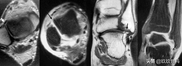 陈旧性踝关节损伤的治疗,踝关节损伤现场处理视频