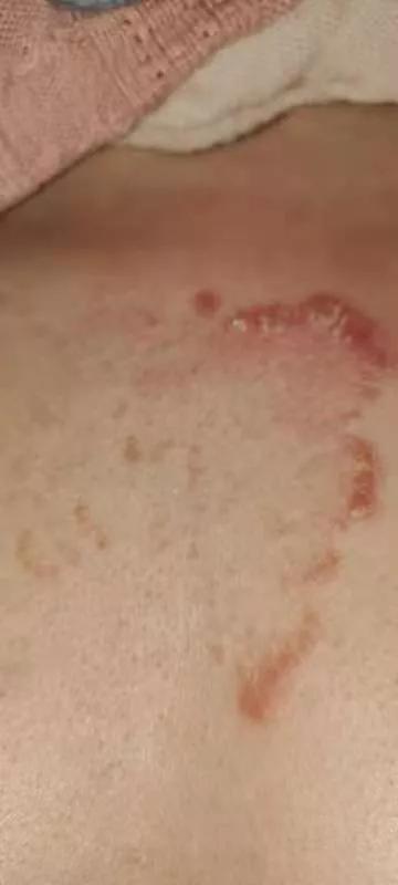 住海南就能使牛皮癣不治自愈吗,牛皮癣和体质有关系吗