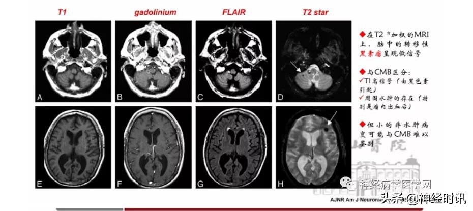 缺血性脑血管病出血评估,脑血管微出血怎么治疗