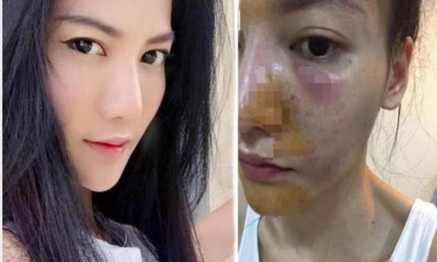 中国人去泰国打美白针,泰国美白针真实事件