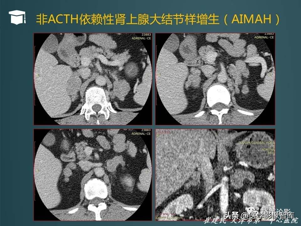左侧肾上腺结节考虑腺瘤与增生,双侧肾上腺增生是什么原因造成的