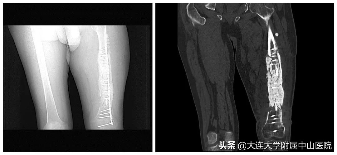 迁延性骨髓炎,慢性骨髓炎最终结局