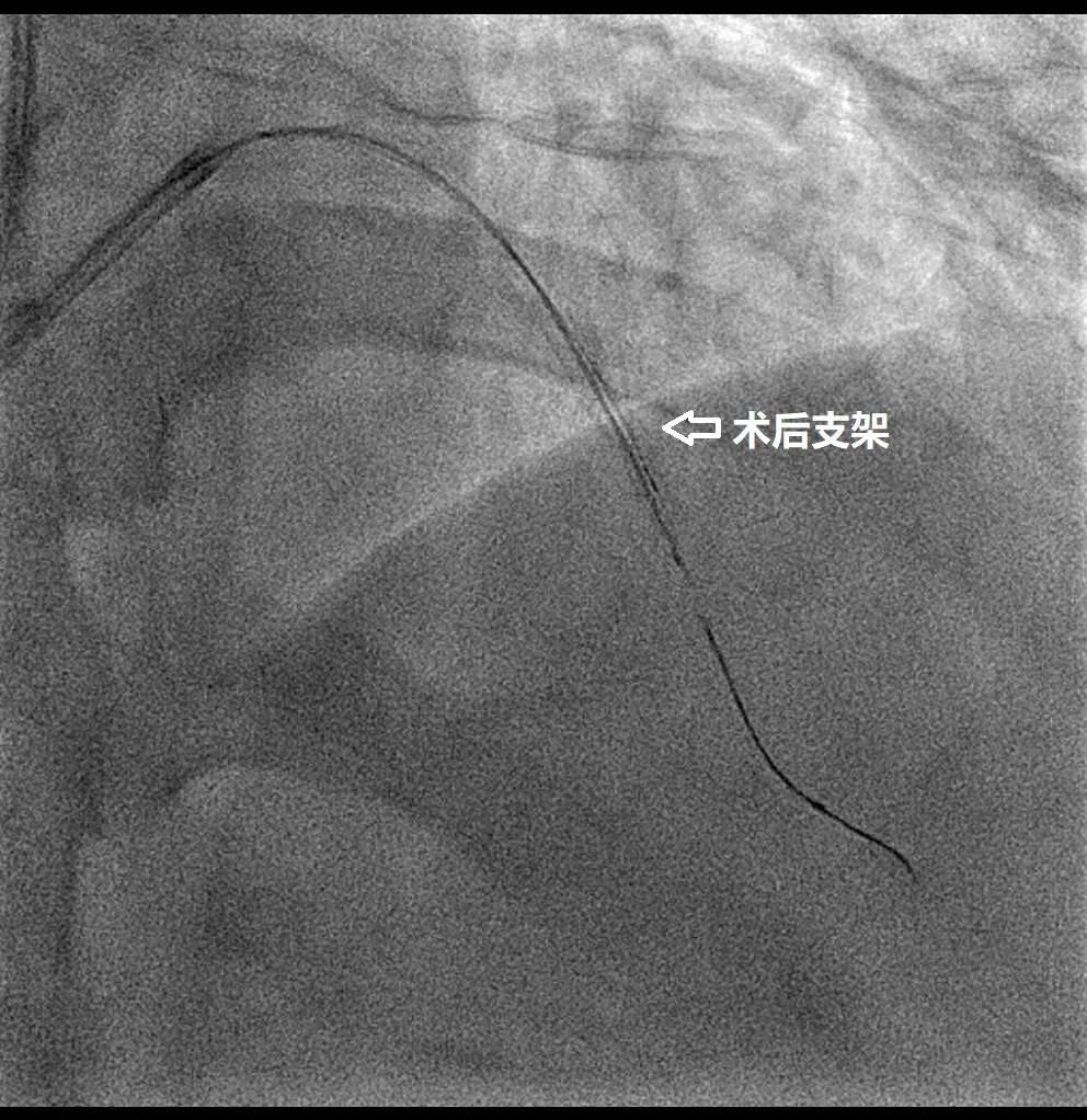 心内科冠状动脉造影术,北医三院介入超声
