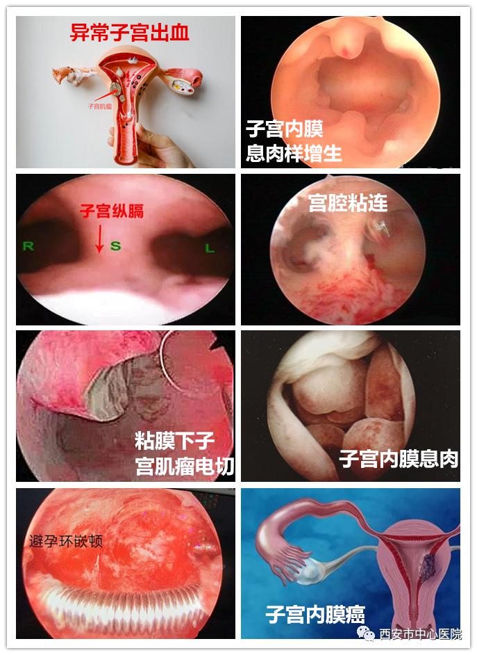 【献礼母亲节】母亲节，别忘了孕育宝宝的宫殿——聊聊宫腔镜的应用