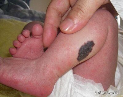 新生儿宝宝胎记,新生儿宝宝脸上的胎记能治吗