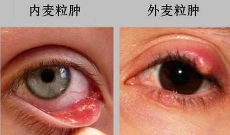 眼皮有个鼓包会自动消失吗,眼皮上长了一个包十天了还没好