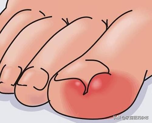 跑步脚趾甲变黑怎么办,跑步脚趾甲变黑是咋回事