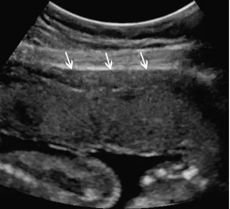 临床上最常见的异常胎盘,前置胎盘和低置胎盘超声