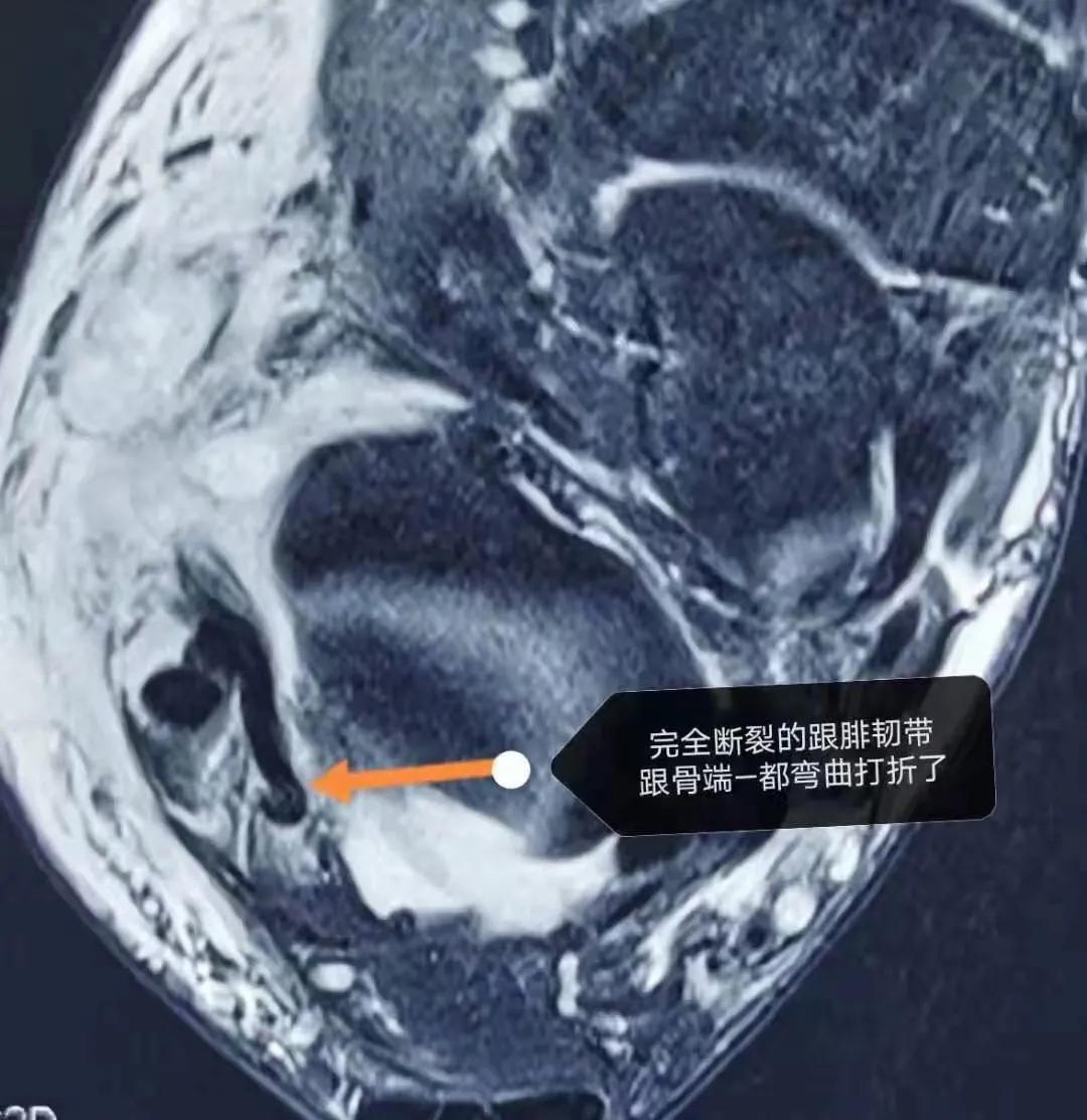 踝关节习惯性扭伤能治愈吗,踝关节扭伤是否伤到骨头