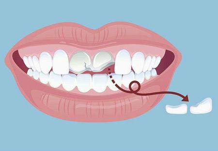 牙齿磕掉了多久可以镶,牙齿磕掉了能装回去吗