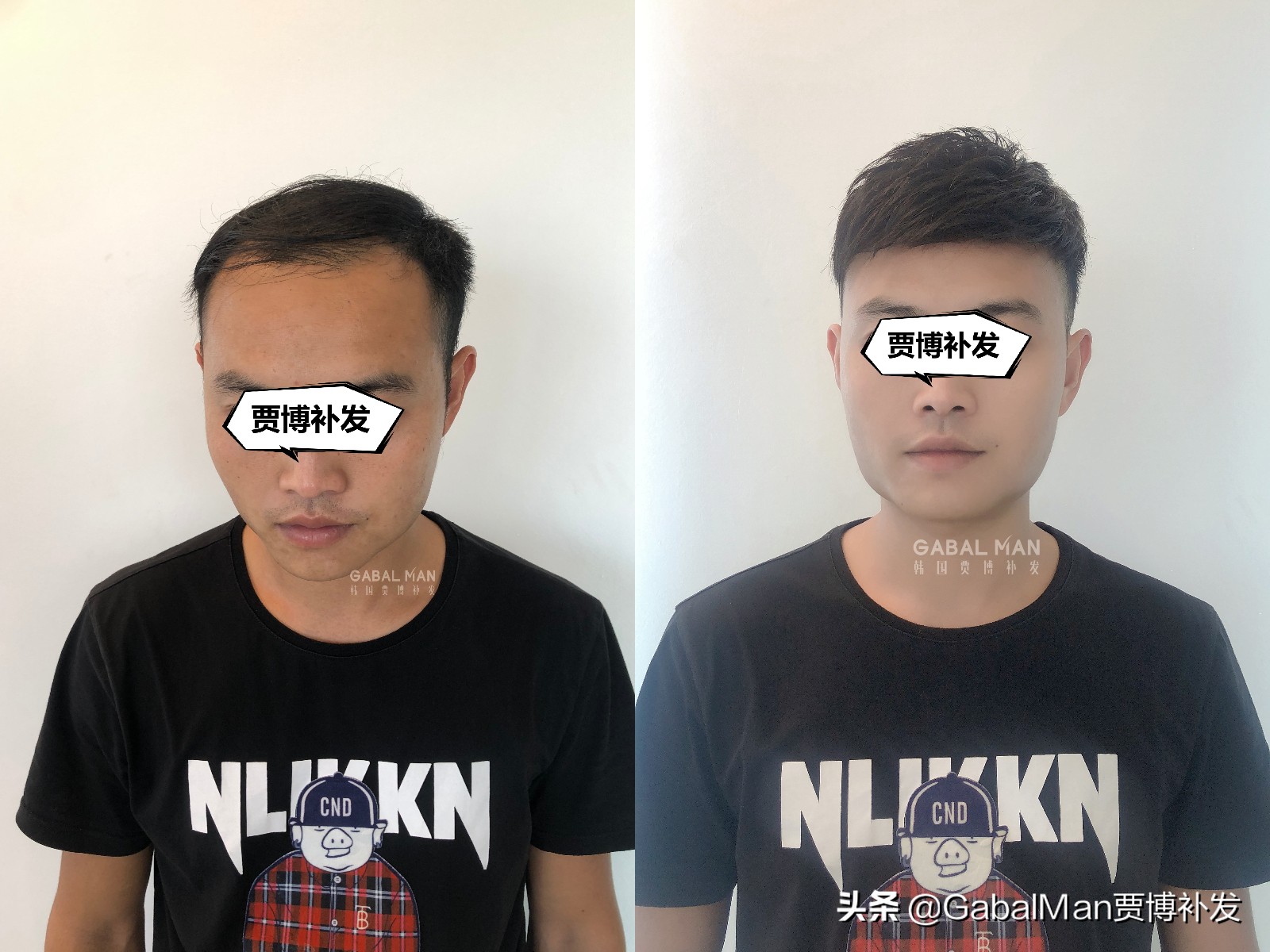 发际线到底该不该注意,发际线高怎么办怎么拯救发际线