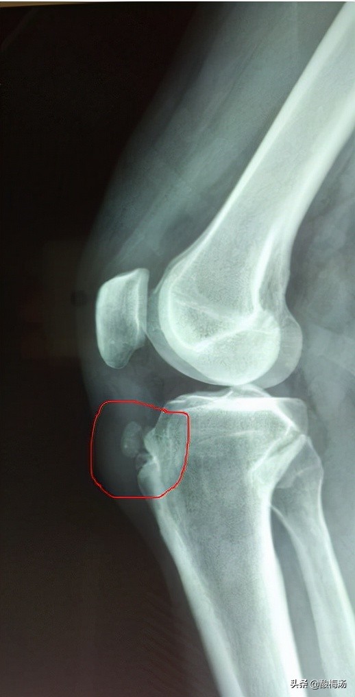 骨骺炎对运动有什么影响,儿童胫骨结节骨骺炎的严重后果