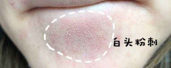 下巴长的白色小颗粒怎么去除,下巴长了很多小颗粒是不是闭口