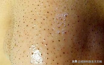 伴随一生的皮肤病,伴随一身的皮肤病有哪些