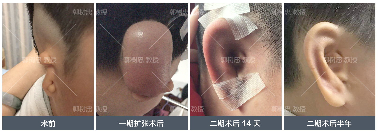 小耳症,小耳症哪里治疗比较好