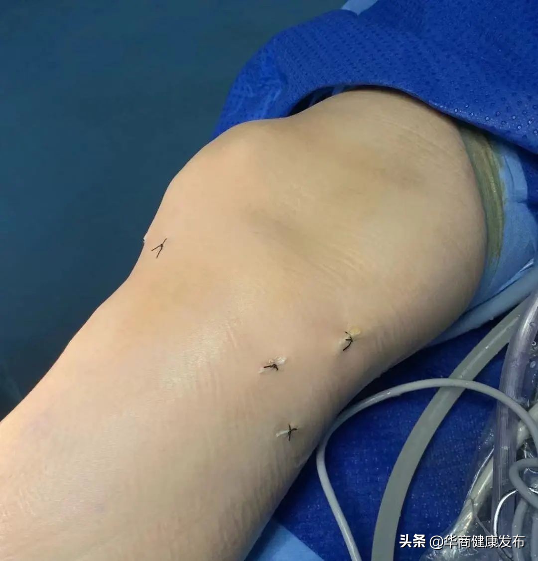 膝盖腘窝囊肿多大要手术,腘窝手术切口