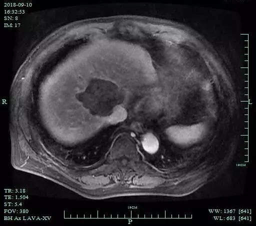 肝癌粒子植入和消融哪个好,肿瘤微波消融