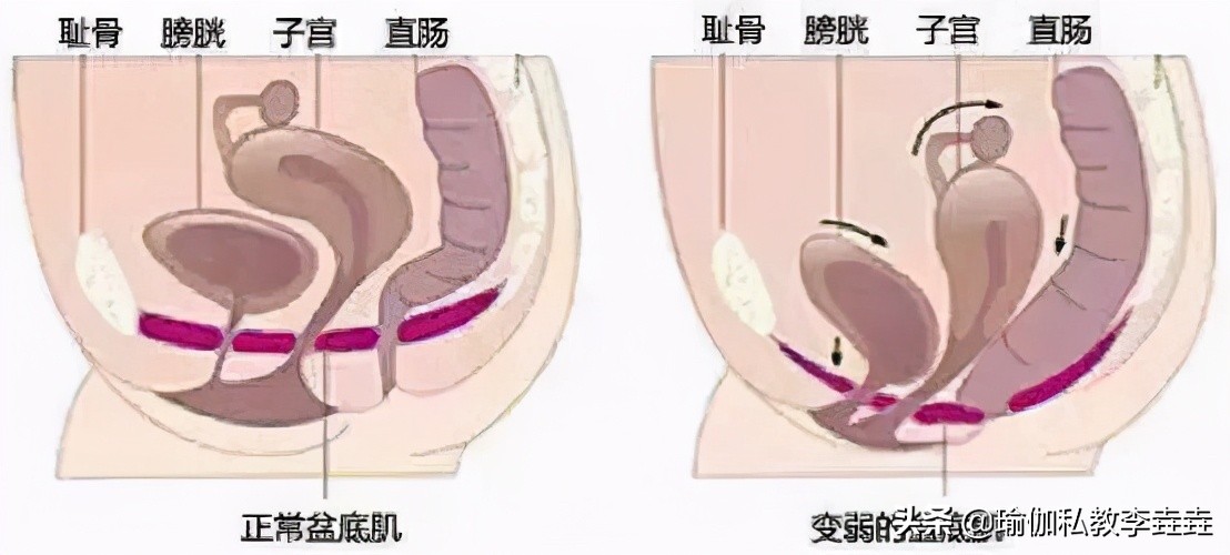 产后多少天可以做修复瑜伽,瑜伽产后修复初级教程在家练