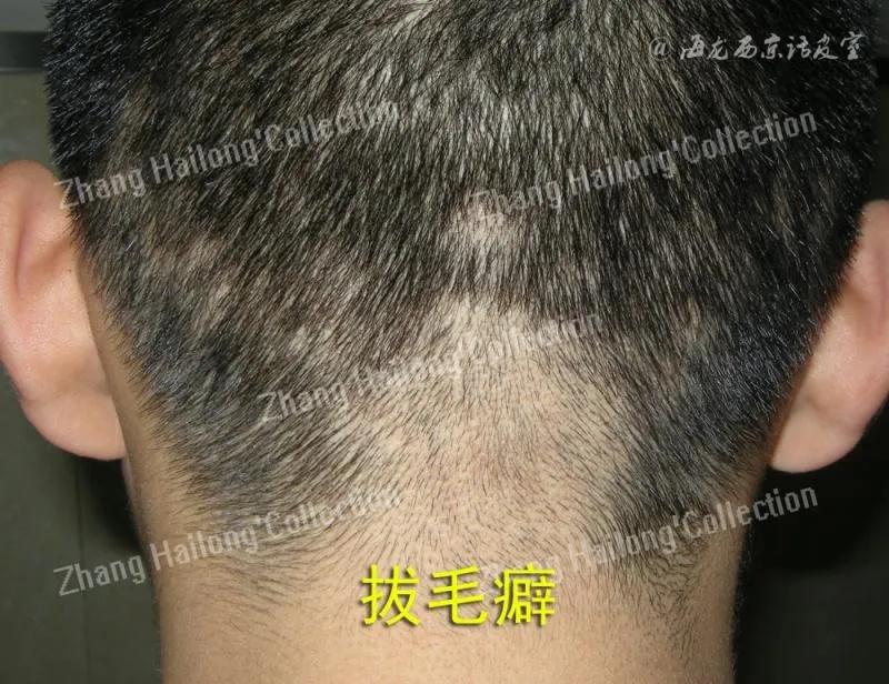 拔毛癖是因为压力吗,拔毛癖是心理问题吗