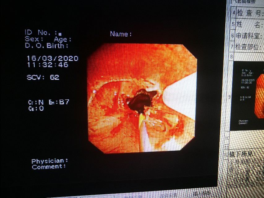 经支气管镜球囊扩张治疗气道狭窄,支气管镜球囊扩张操作视频