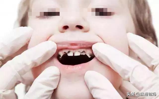 儿童每天刷牙为啥还有虫牙,小孩天天刷牙牙齿上还是黄黄的