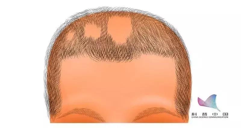 鬼剃头是怎么造成的,鬼剃头究竟是怎么回事