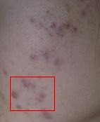 痘痘肌大作战视频教程,痘痘肌的修复