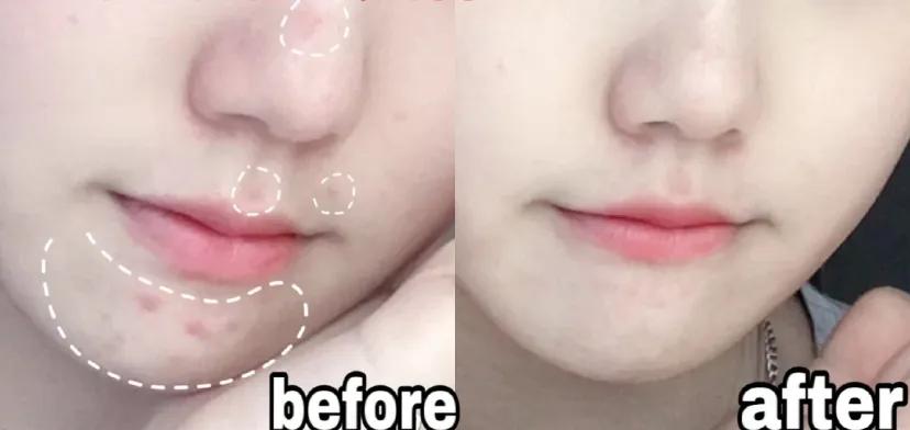 片仔癀痘痘贴效果怎么样,片仔癀清痘系列真的有用嘛