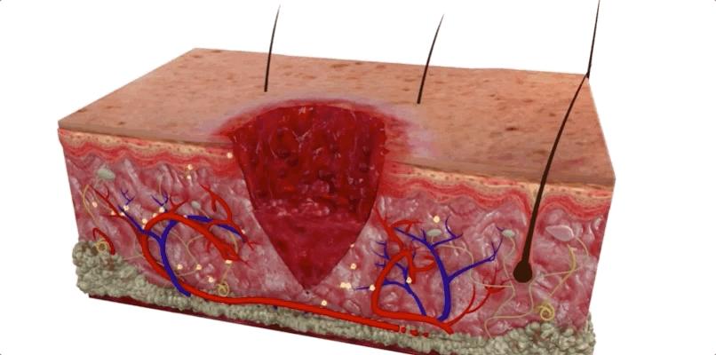 怎么恢复愈合伤口留下的疤痕,科普短片伤口是如何愈合的