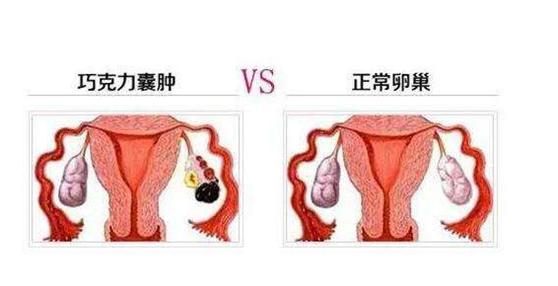 为什么会得巧克力囊肿女性要警惕,巧克力囊肿严重还是卵巢囊肿严重
