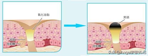 草莓鼻黑头去除收缩毛孔,黑头清理攻略草莓鼻必看下篇