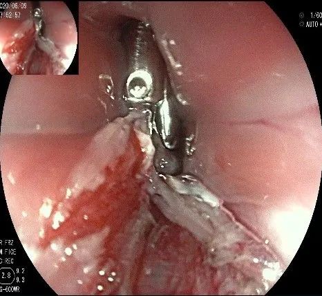 贲门隆起性病变影像,贲门溃疡隆起性病变