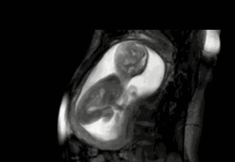 胎儿在妈妈肚子里干什么图片,胎儿在妈妈肚子里的位置变化