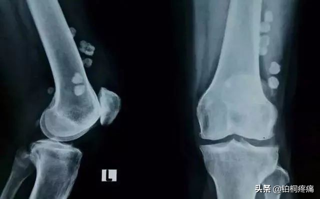 老年人膝盖水肿痛的三大病因,左脚膝盖后面酸痛是什么病因