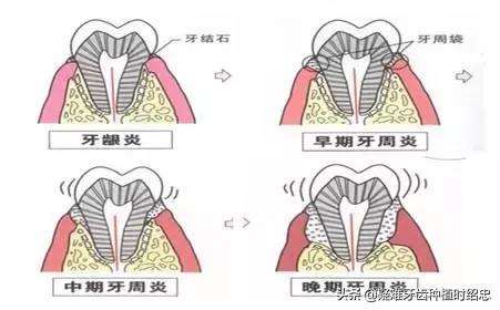 牙周炎牙齿松动要拔掉吗,牙周炎引起牙齿松动严重需要拔吗