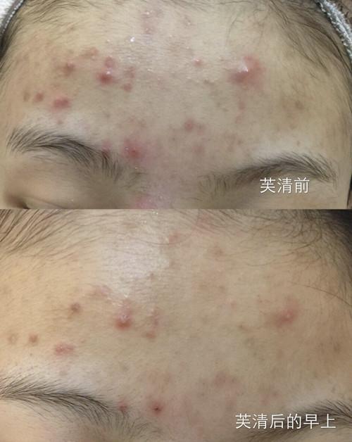 12款热门医美面膜攻略：有人治好皮炎，肤白貌美；有人悔不当初