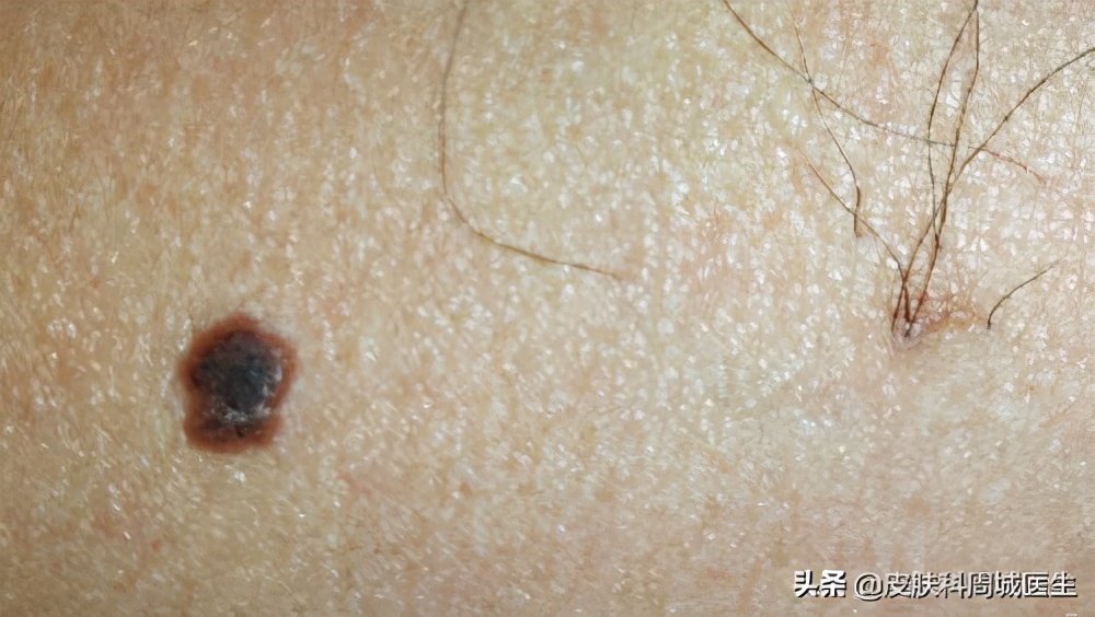 激光点痦子后可以运动么,激光点痦子后要注意什么