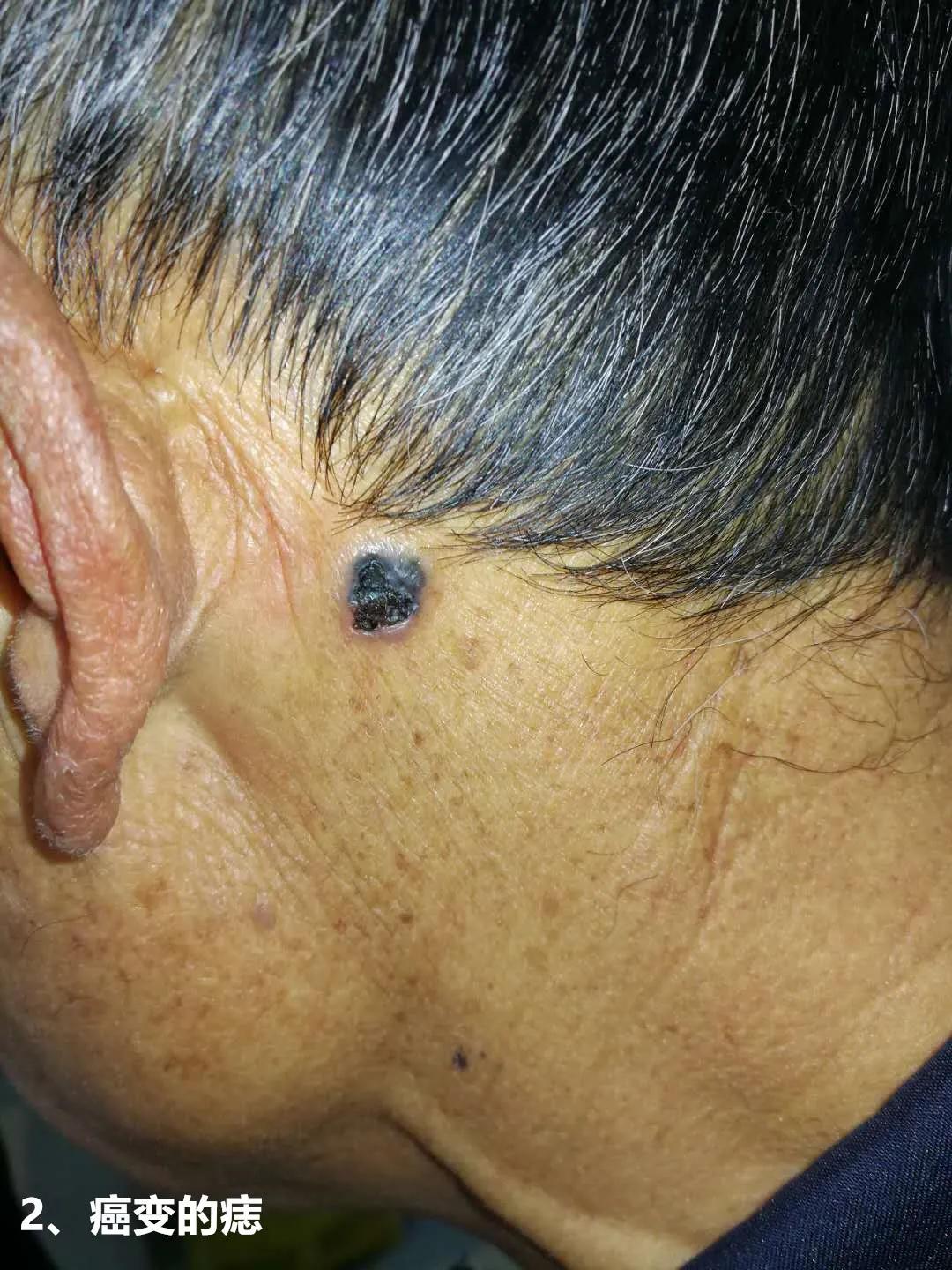 身上有痣到底要不要切除做病理,身上的痣会不会癌变一张图告诉你