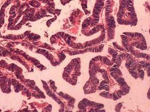 中医治疗中晚期胆囊癌效果如何,胆囊癌晚期只用中医治疗效果如何