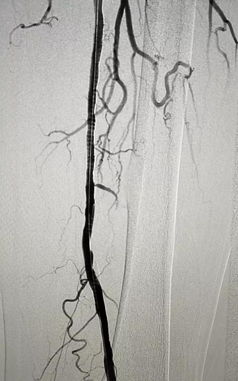 下肢血管引起的腿软无力,下肢动脉闭塞会引起腿无力吗