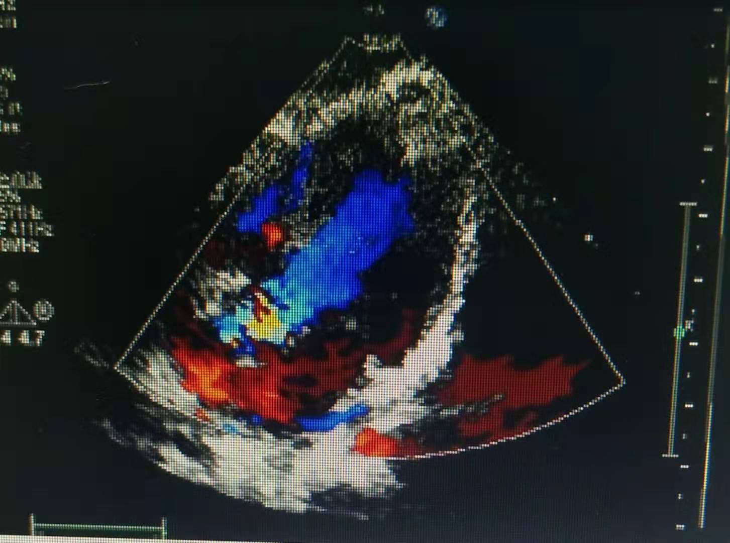 患儿川崎病好转后发烧感冒怎么办,川崎病治愈后娃娃腹泻是怎么回事