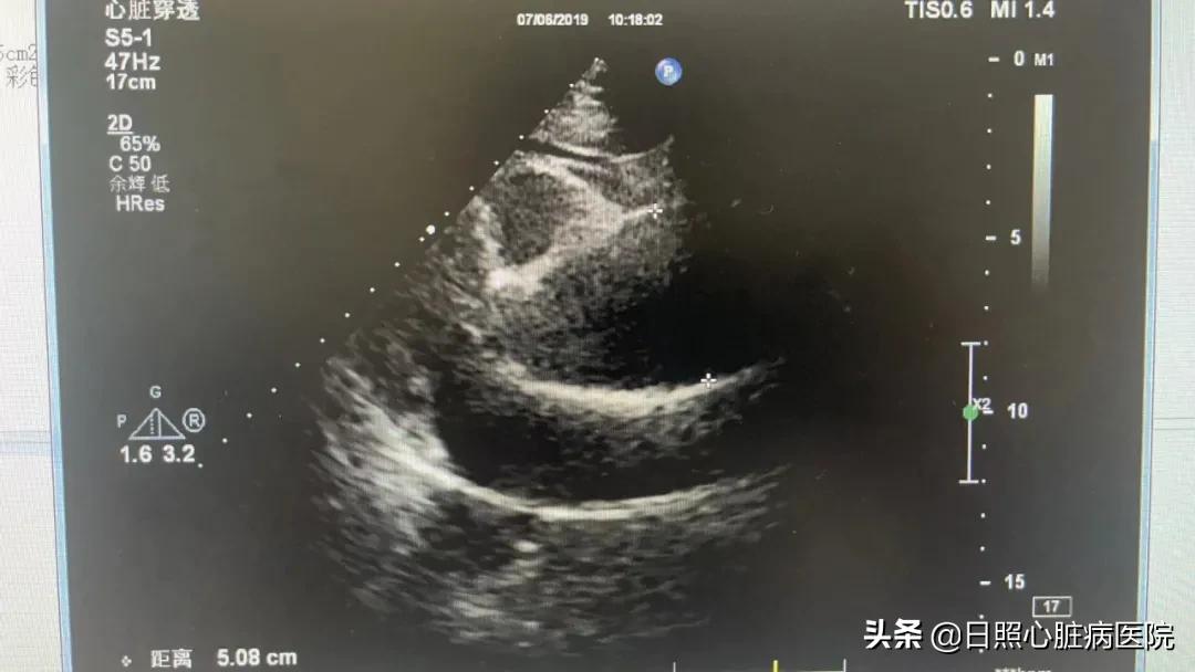 主动脉瘤最典型的症状,主动脉瘤死亡率高的表现