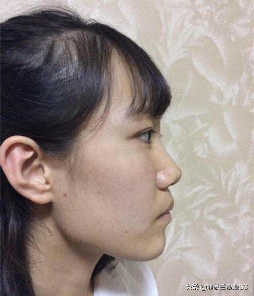 怎么减掉脸部的赘肉,怎么减掉脸颊上的肥肉