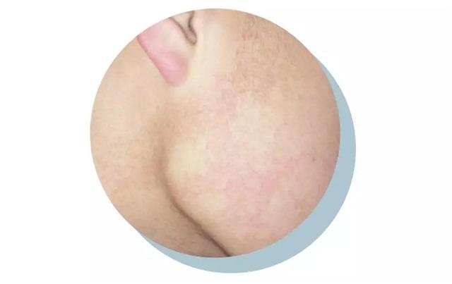 顽固多年黑头闭口毛孔粗大怎么办,南京皮肤病研究所顽固闭口粉刺