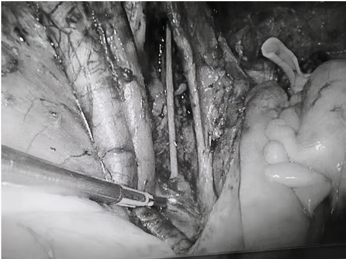 西青医院妇科顺利完成一例腔镜下子宫内膜癌一次全面分期手术