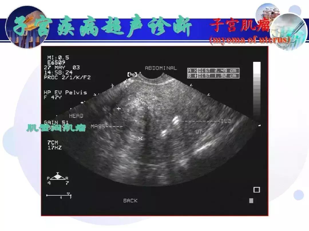 纯干货！子宫及附件解剖和超声诊断